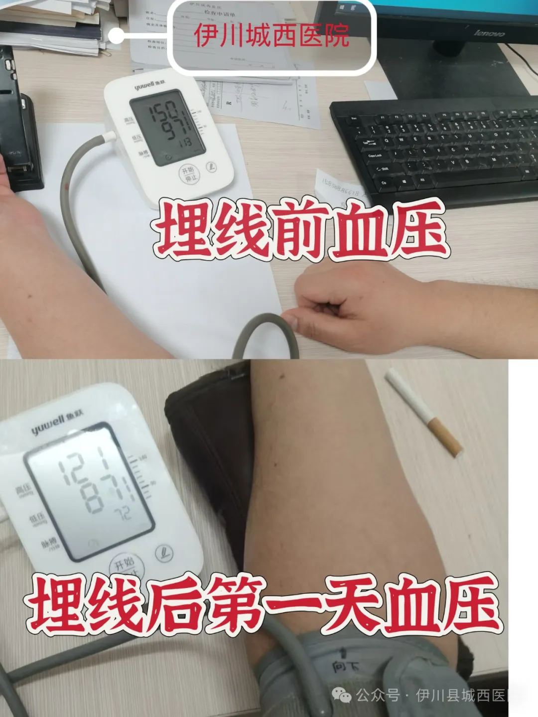 埋线前血压